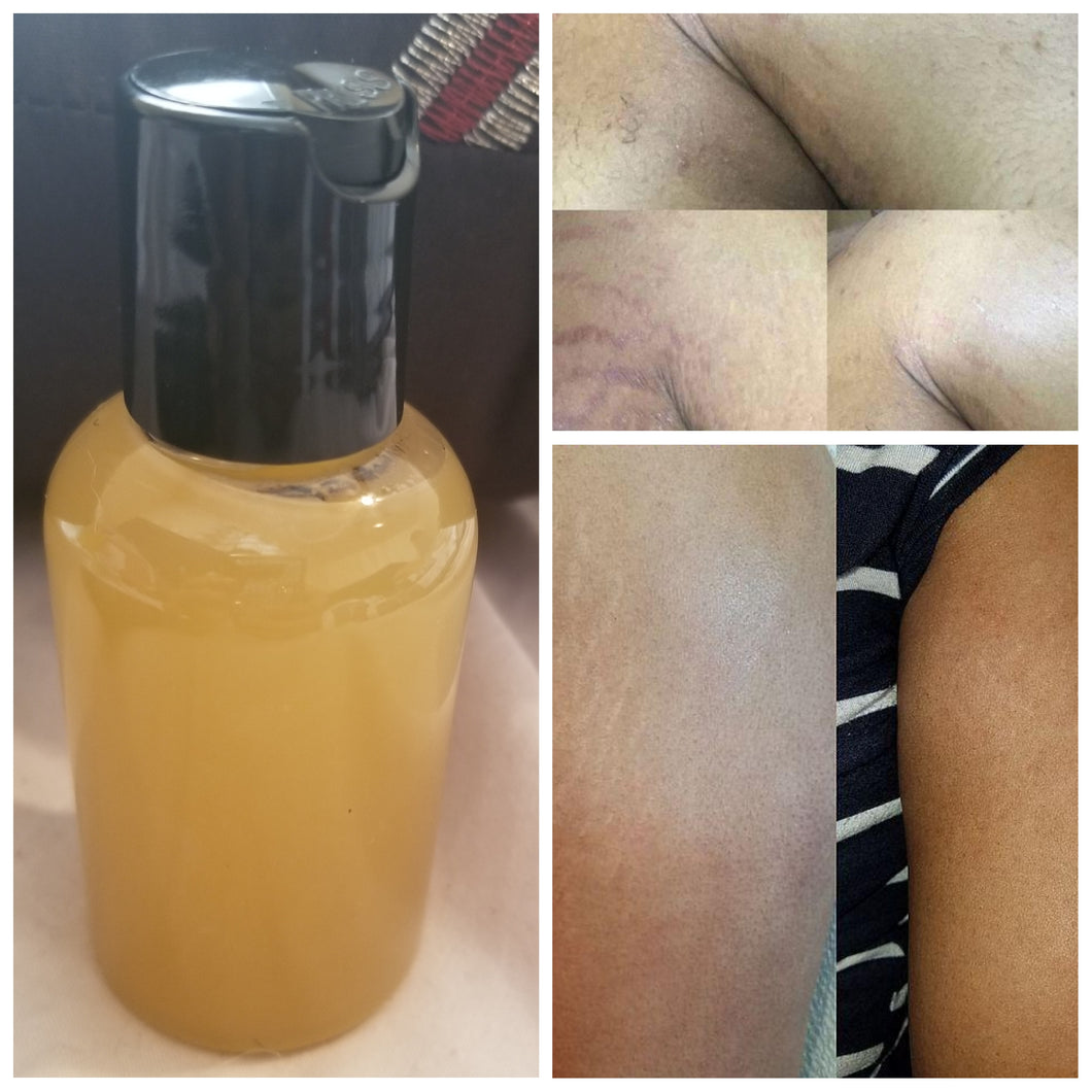 Stretch Mark Oil